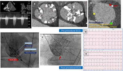 Case report: Transcatheter aortic valve replacement in a large bicuspid anatomy using the XL-Myval 32 mm